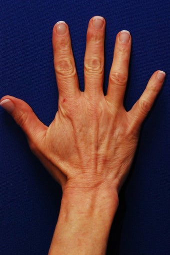 Radiesse Hand Rejuvenation