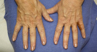 Radiesse Hands 