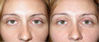 filler to under eye-cheek 