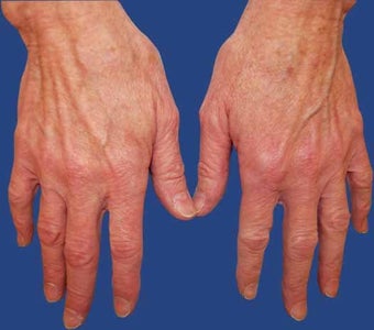 Dermal Filler for Hand Rejuvenation