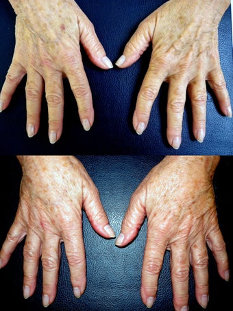 Filler of Doral Hands