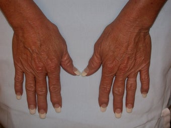 Before & After Hand Rejuvenation