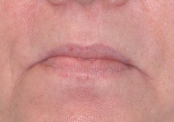 Radiesse and Restylane for Marionette Lines and Lips