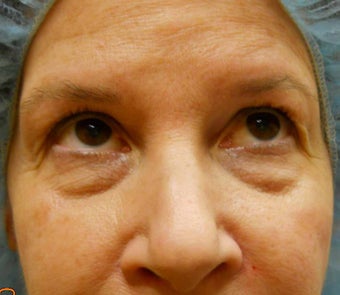 Under-Eye Filler Treatment
