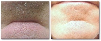 Radiesse to fill in chin crease