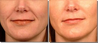 Radiesse to smile lines
