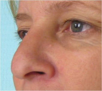 Radiesse on nose