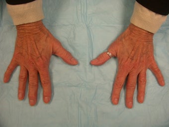 Hand Rejuevnation with Radiesse