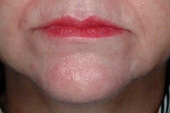 Radiesse and Botox