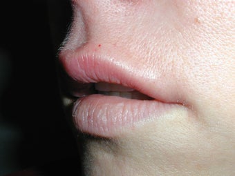 Restylane for upper lip