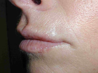 Restylane in Upper Lip
