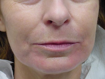 Restylane treatment for marionette lines 