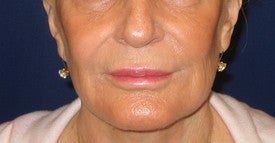 Restylane injection into lips and nasolabial folds