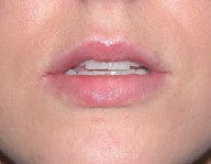 Injectables 