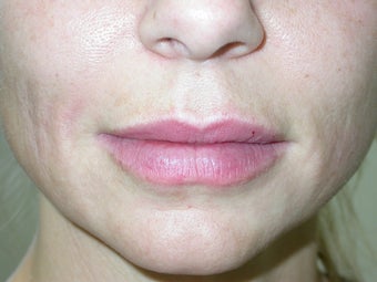 Filler -lip augmentation and smile line treatment