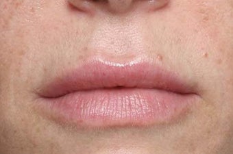 Lip treatment with Restylane®
