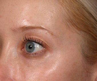 Restylane under eyes