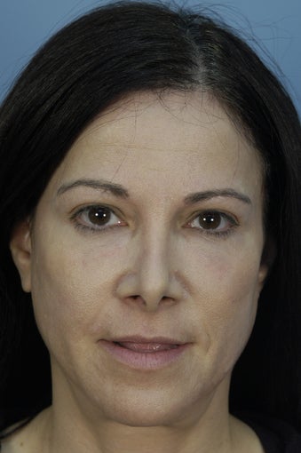 Filling under eye Hollows with Restylane