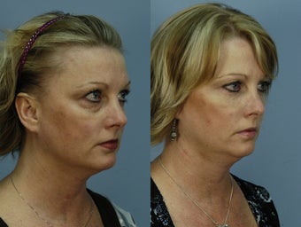 Restylane filling the under eye hollows VUE (tm)