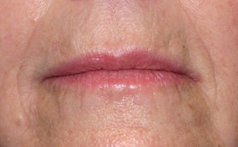 Restylane injection to nasolabial folds