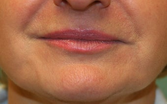 Restylane around the mouth