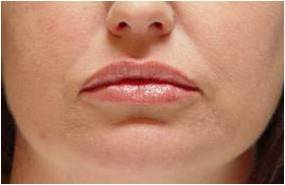 Lip augmentation