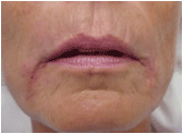 Restylane