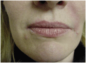 restylane 