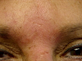 Immediate Improvement of a Forehead Wrinkle