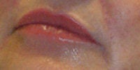 Restylane