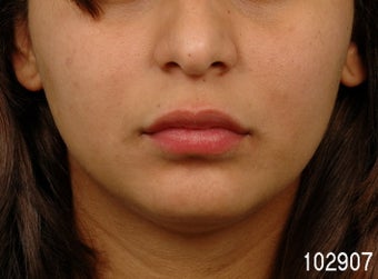 Lip Augmentation