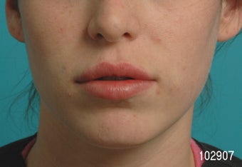 Lip Augmentation