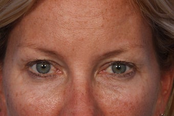 Restylane to Tear Trough (under eyes)