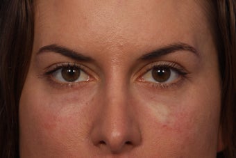 Restylane to Tear Troughs (under eyes)