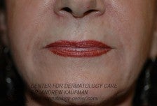 Dermal Filler Injection to Marionette and Accessory Smile Lines