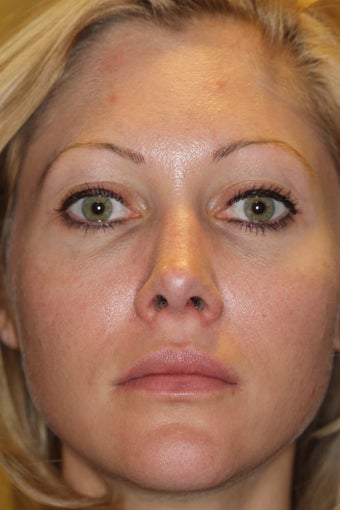 Restylane to Lips