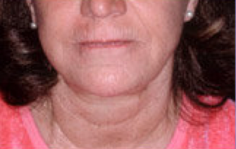 Extreme filler a.k.a liquid facelift