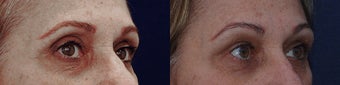 Upper eyelid filler with restylane