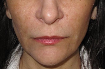 Restylane