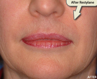 Restylane FIller Augmentation of the Nasolabial Folds