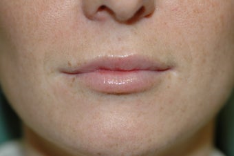 Lip augmentation