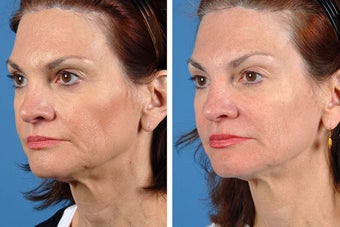 Fillers and Botox Cosmetic