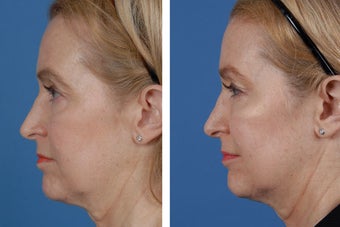 Restylane and Botox Cosmetic