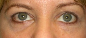 Restylane for eyes