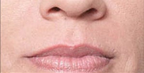 Restylane®