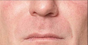 Restylane®
