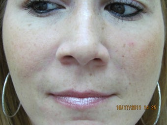 Restylane