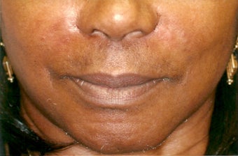 Restylane injection