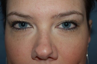 Restylane used in tear trough 