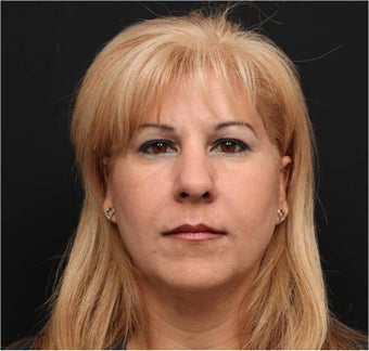 Restylane & Juvederm